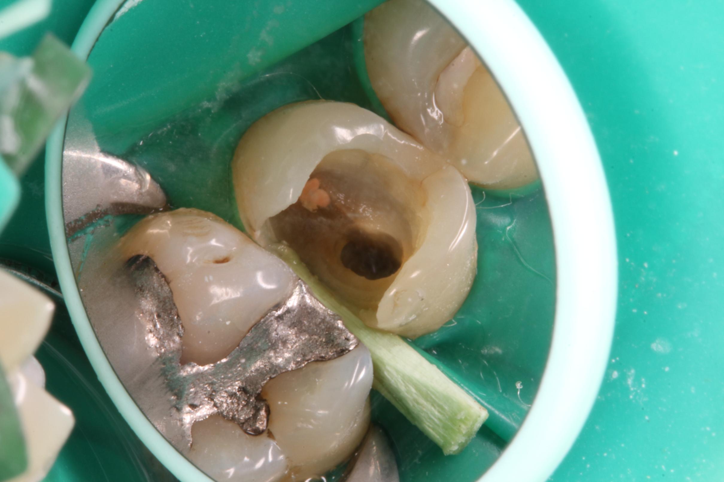Endodoncia